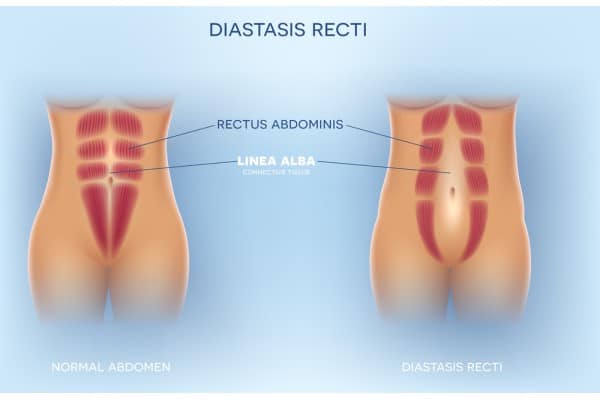 What Non-Surgical Options Are Available for Diastasis Recti Scotstounhill?