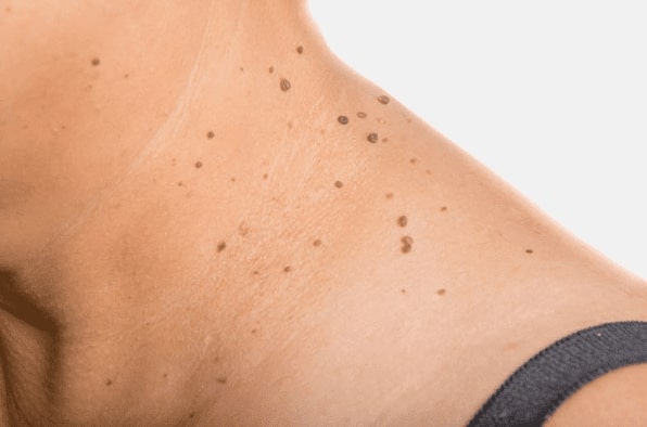 Are you looking for easy skin tag removal Scotstounhill - then contact Spire today!