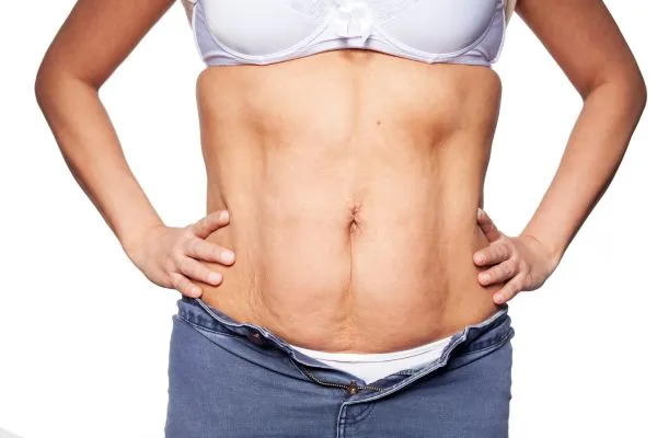 sagging skin on woman's stomach after weight loss injections Scotstounhill