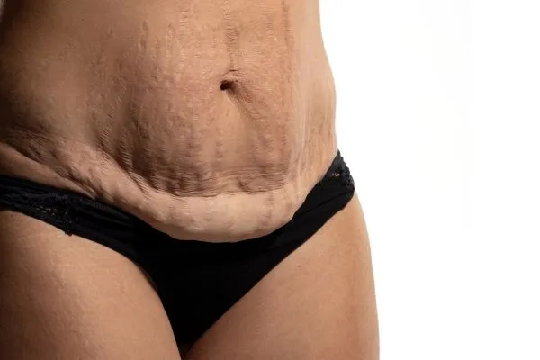 Image of womans stomach after weight loss injections Scotstounhill showing saggy skin